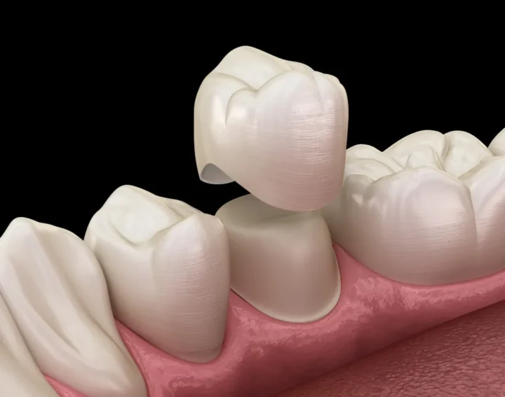 5 Important Benefits of a Dental Crown
