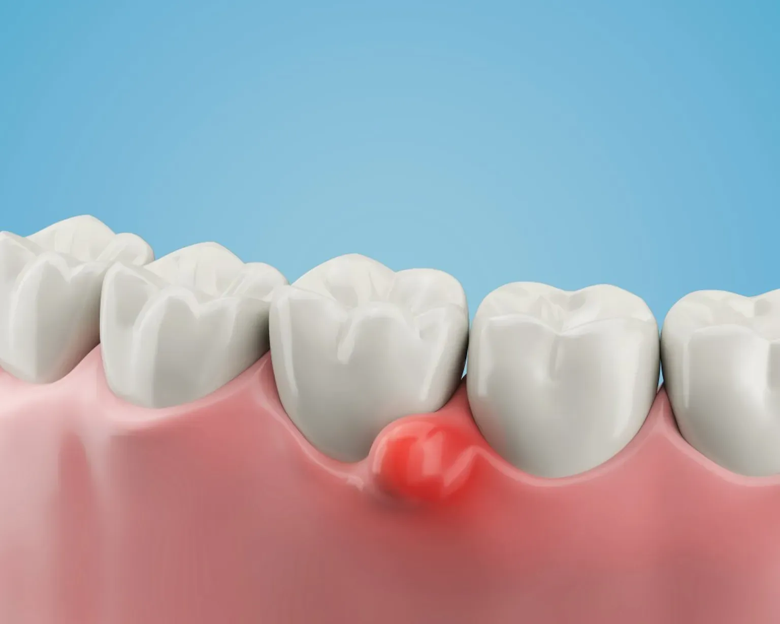 Deep Dental Cleaning: How Scaling and Root Planing Treats Gum Disease