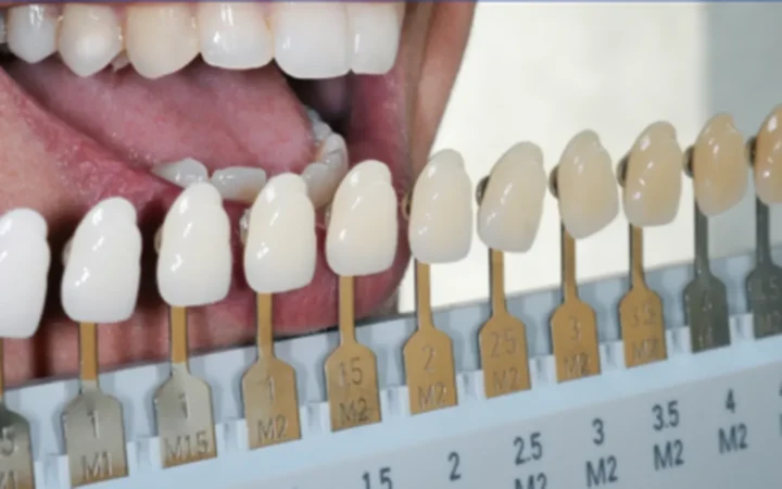 “I want my teeth WHITER!” – We Offer In-Office Whitening