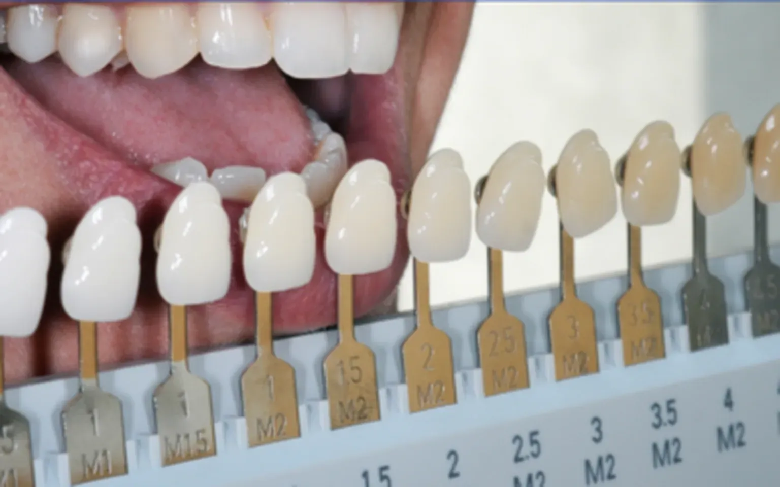 “I want my teeth WHITER!” – We Offer In-Office Whitening