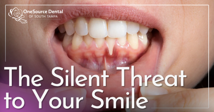The Silent Threat to Your Smile patient showing lower gums