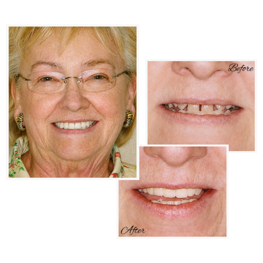 Horton - B & A Anterior Bridges v2